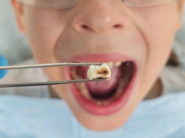 Best Emergency Wisdom Teeth Removal in Pumpkin Center, NC