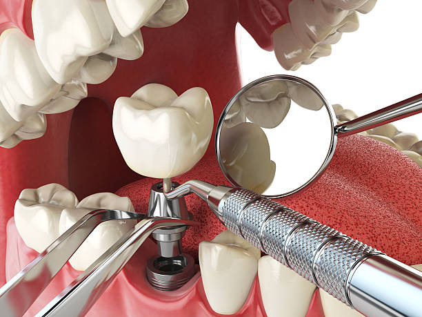 Best Emergency Wisdom Teeth Removal in Pumpkin Center, NC